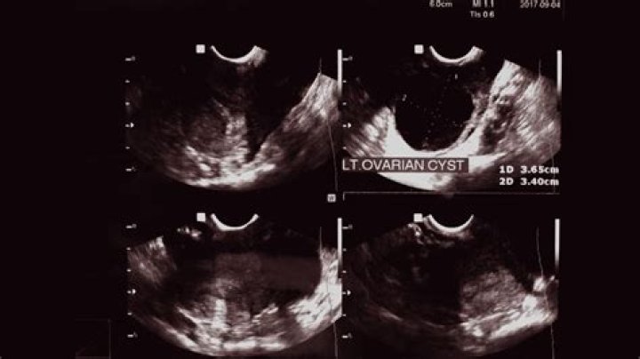 Are ovarian and breast cysts related?