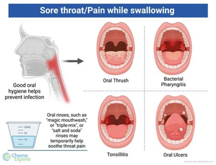 Can a sore throat be passed on by kissing?