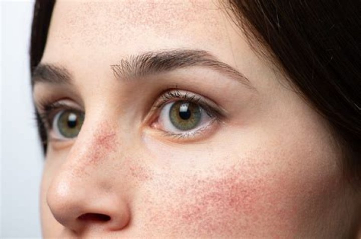 Does flushed skin go away?