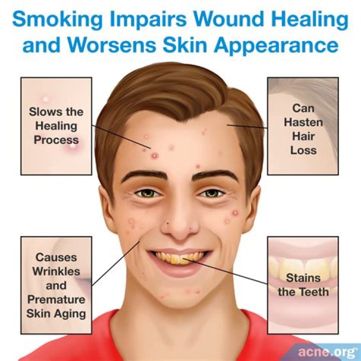 Does smoking cause acne?
