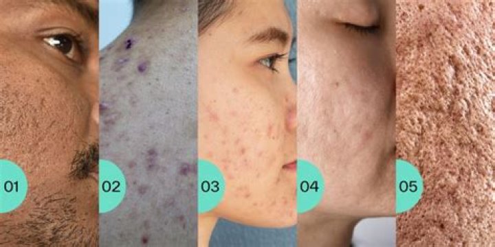 Does trinessa lo help acne?