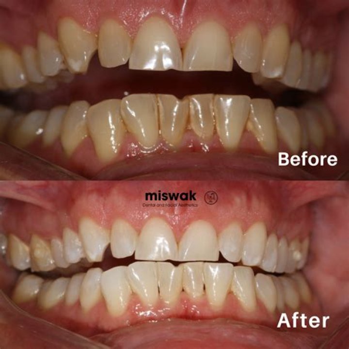 Does using miswak whiten teeth?
