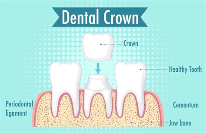 How long do dentists guarantee crowns?