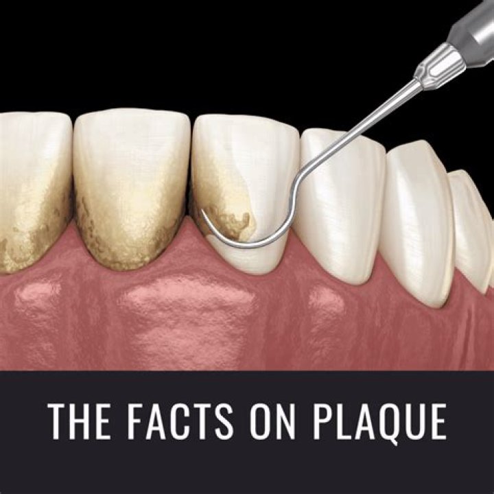 How plaques are formed?