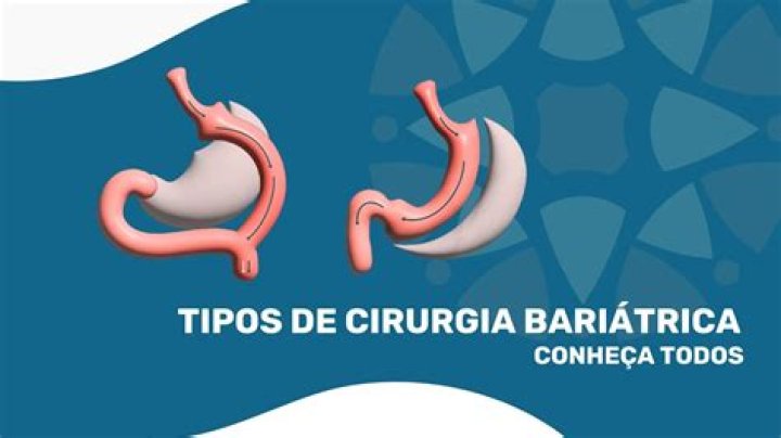 Quais tipos de barriga existem?