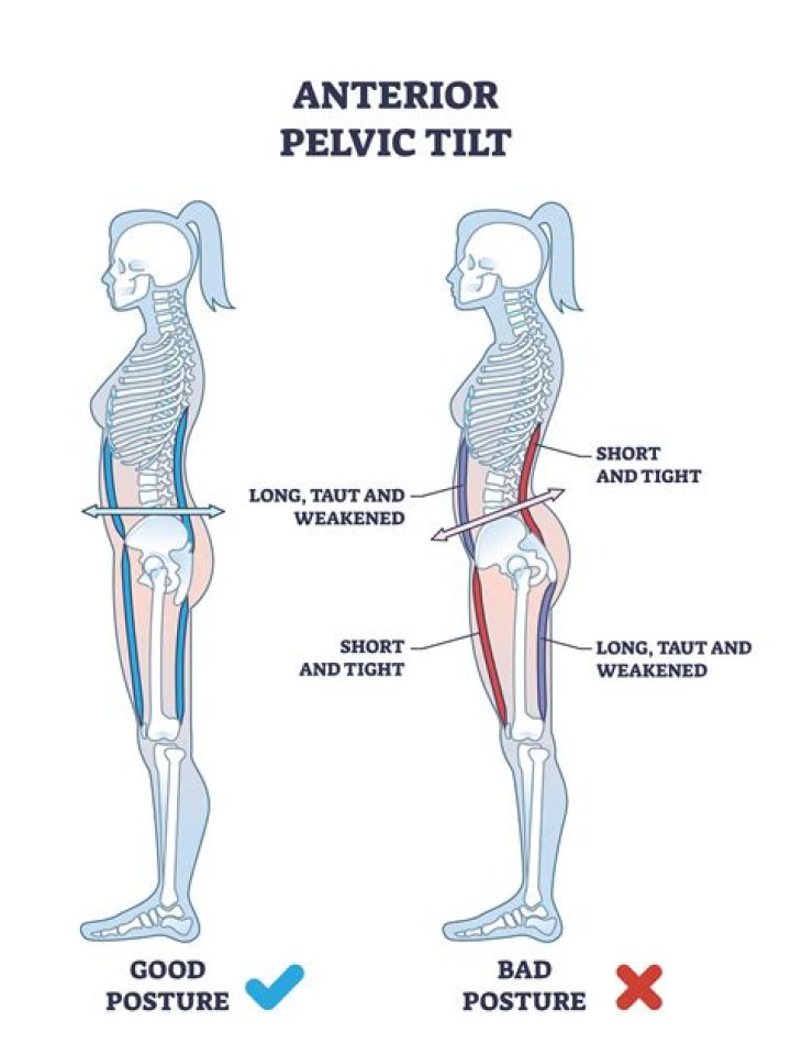 Should i deadlift with anterior pelvic tilt?