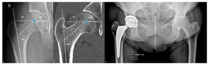 Was ist femoral head?