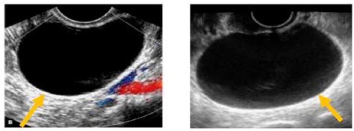 Was ist ovarian cyst?
