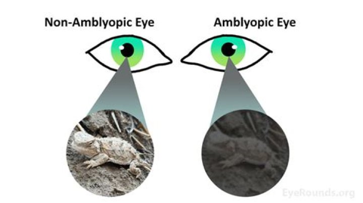 What's amblyopia ex anopsia?