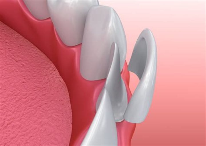 What are daVinci veneers?
