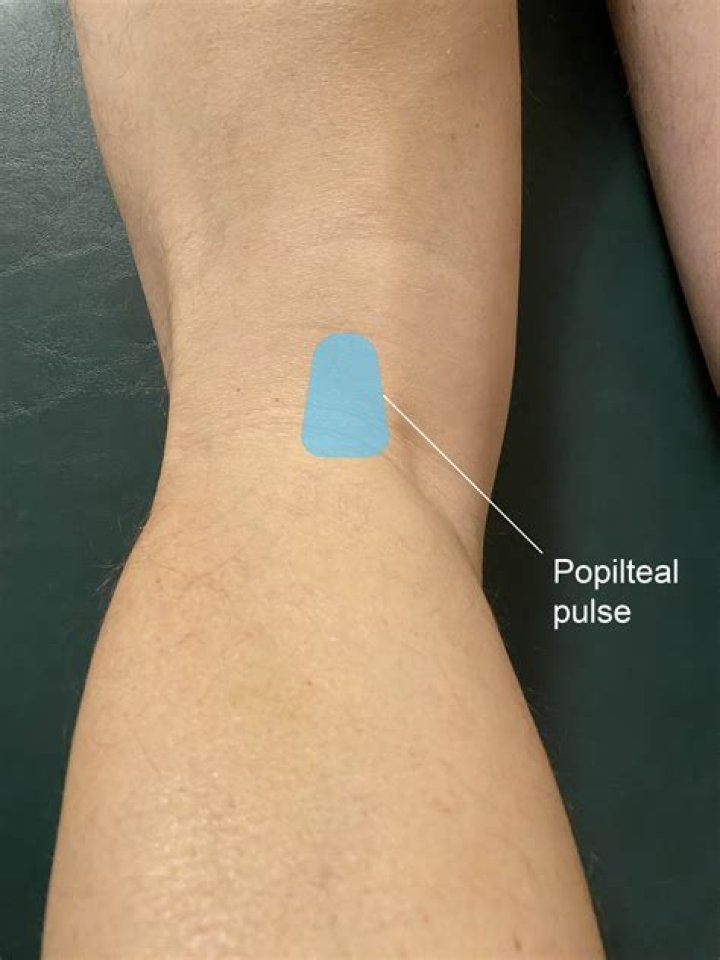 When to check femoral pulse?