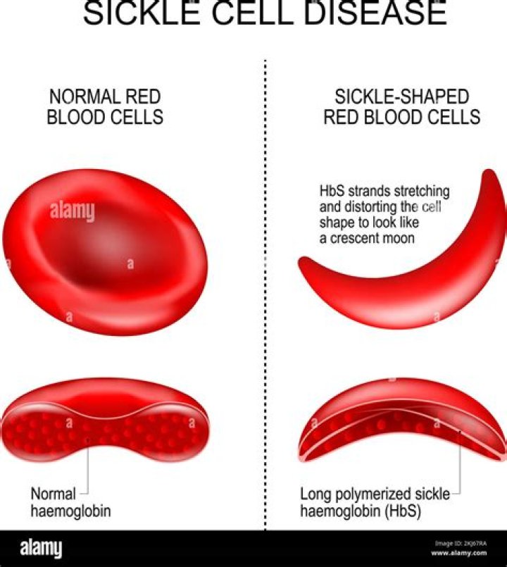 Which conditions predispose a person with sickle cell anemia to develop sickling of hemoglobin?